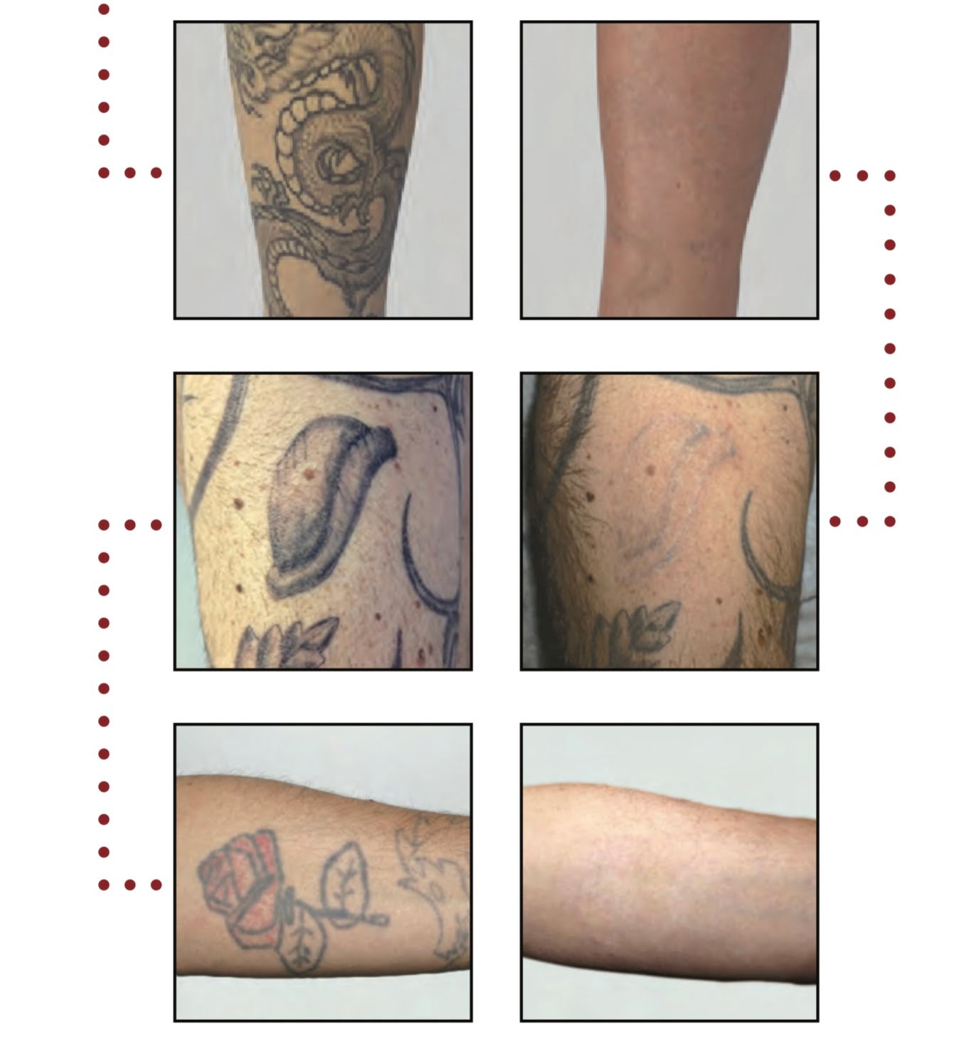 Laser Tattoo Removal LCV Beauty Aesthetics laser-tattoo-removal-lcv-beauty-aesthetics