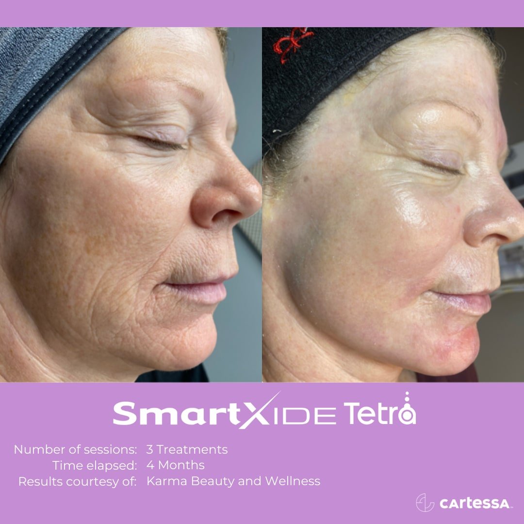 Tetra Fractional CO2 Laser – LCV Beauty Aesthetics